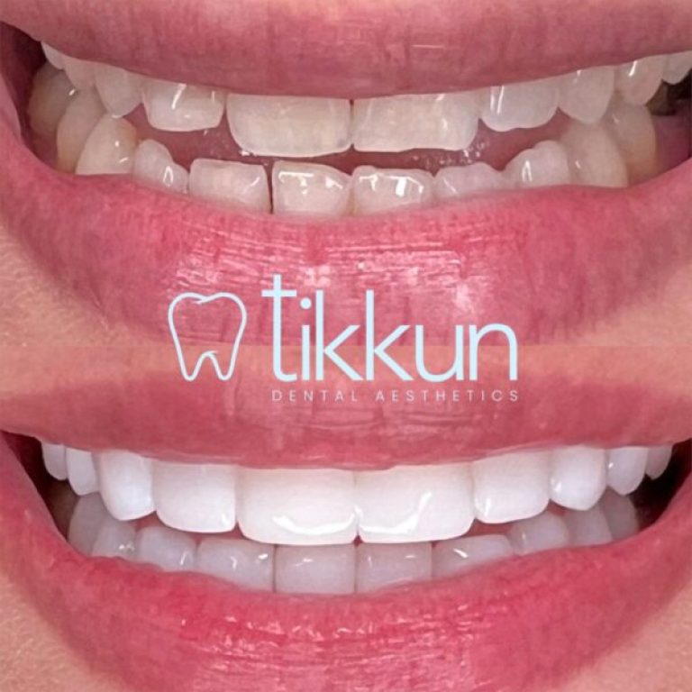 Diseno-de-sonrisa-con-carillas-en-resina-Tikkun Dental Pro